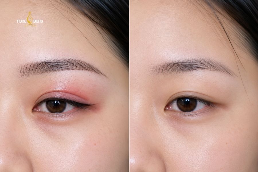 Phun xăm mí mắt bị sưng thì phải làm sao? Có sao không? 14 Sưng mí mắt sau khi phun xăm là hiện tượng bình thường