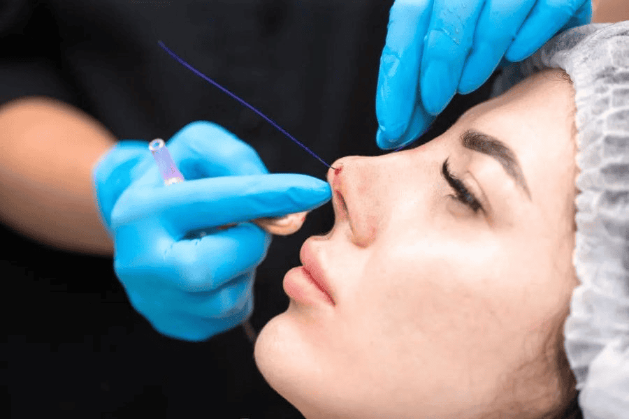 Sợi chỉ tạo ra lực nâng cơ học trực tiếp, nâng cao sống mũi và định hình dáng mũi ngay sau thủ thuật