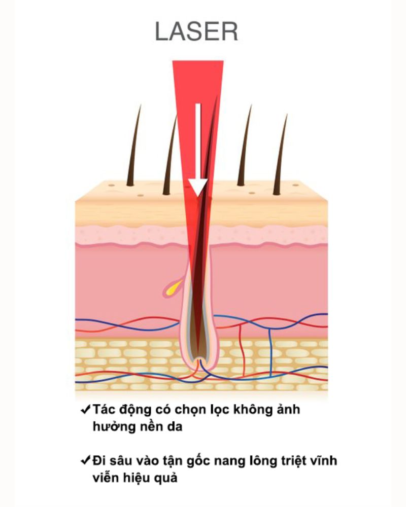 Laser giúp triệt tận gốc nang lông