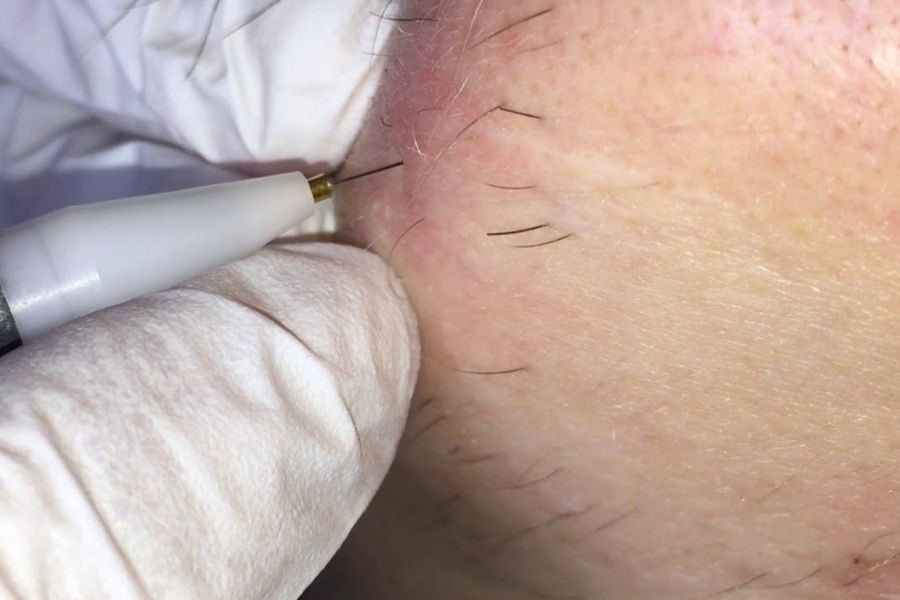 Triệt lông chân là gì? Phương pháp, liệu trình và chi phí 14 Triệt lông điện phân đòi hỏi chuyên viên có tay nghề cao