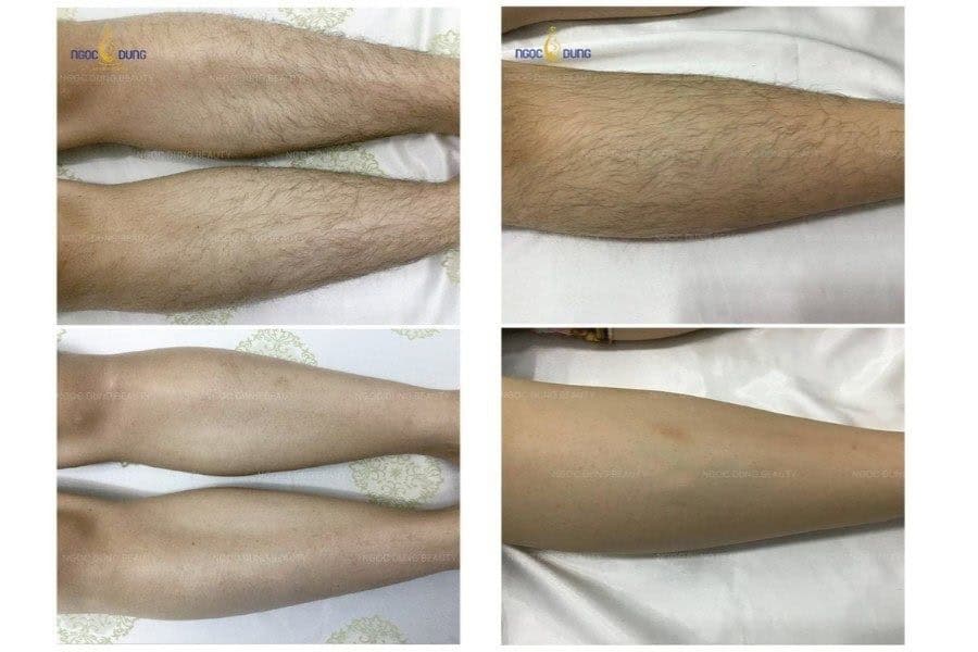 Kết quả triệt lông công nghệ New Elight tại Ngọc Dung