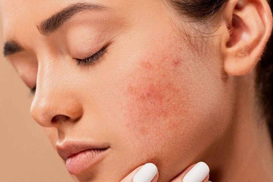 Viêm nang lông không gây nguy hiểm nhưng cần điều trị sớm
