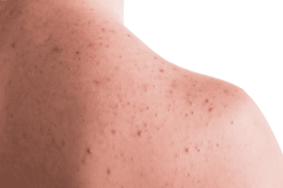 Viêm nang lông có thể lây nếu tác nhân là virus hoặc vi khuẩn