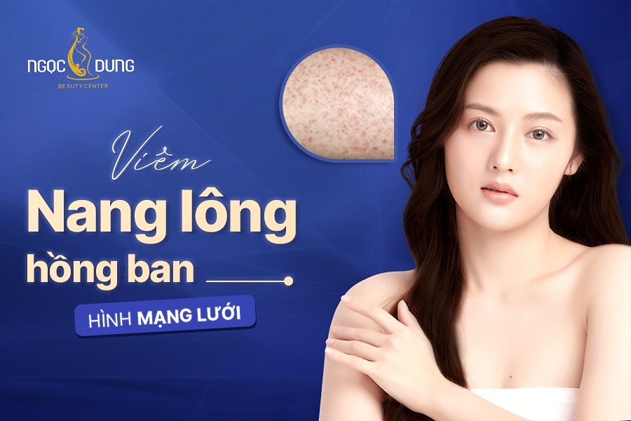 Viêm nang lông hồng ban hình mạng lưới