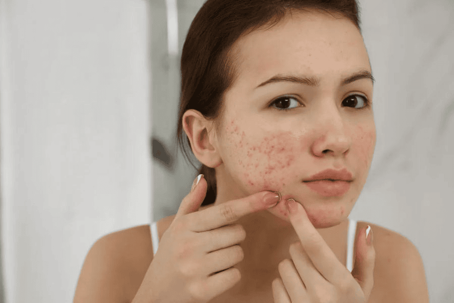 Viêm nang lông mặt thường có những dấu hiệu như mụn mủ nhỏ có đầu trắng, ngứa và châm chích tại vùng tổn thương