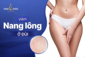 Viêm nang lông ở đùi