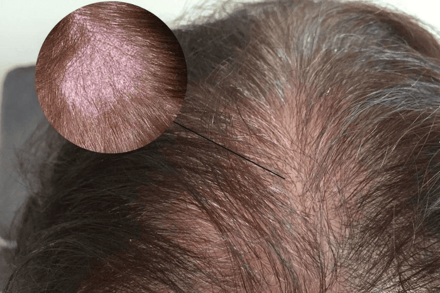 Do sự xâm nhập của vi khuẩn, virus và các loại nấm dẫn đến viêm nang lông da đầu