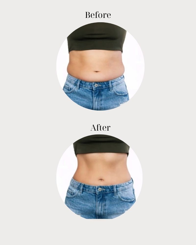 Giảm 25% tỉ lệ mỡ mỗi lần điều trị