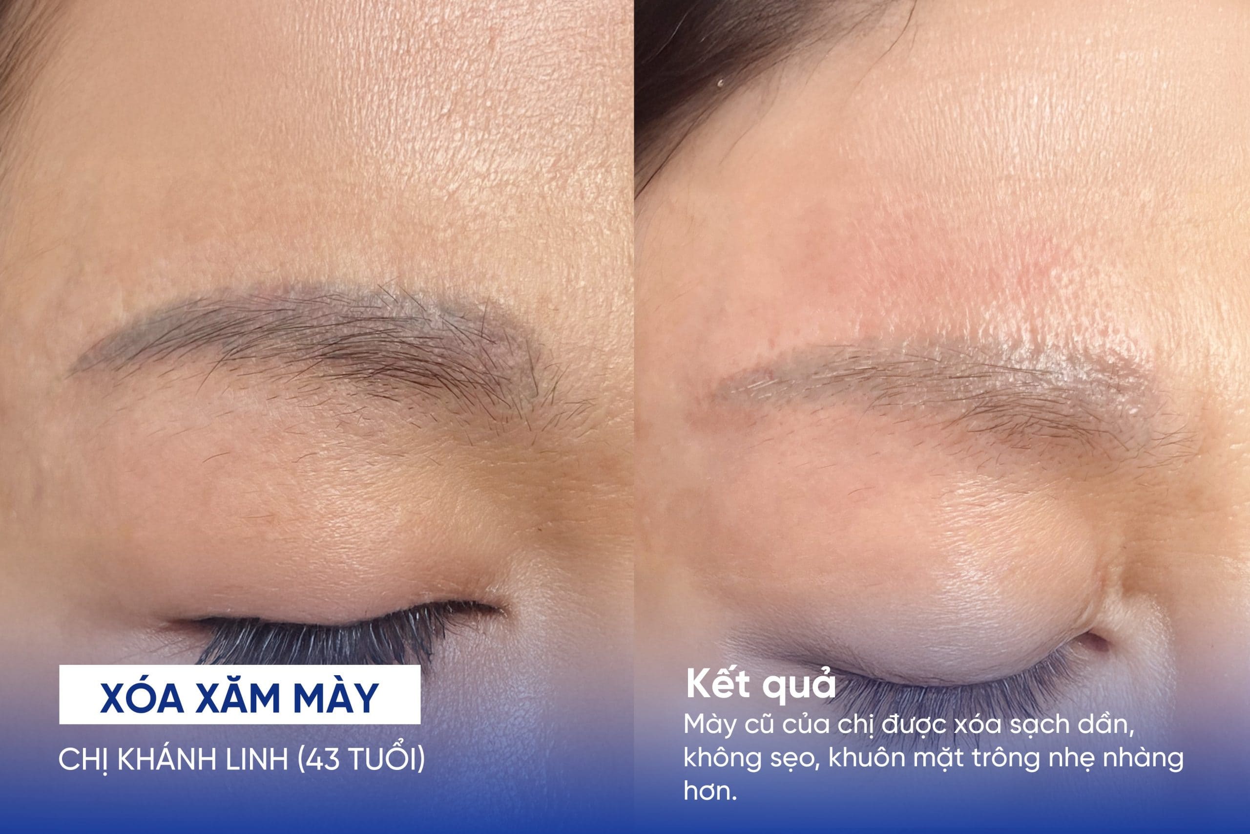 Kết quả xóa xăm mày của chị Khánh Linh