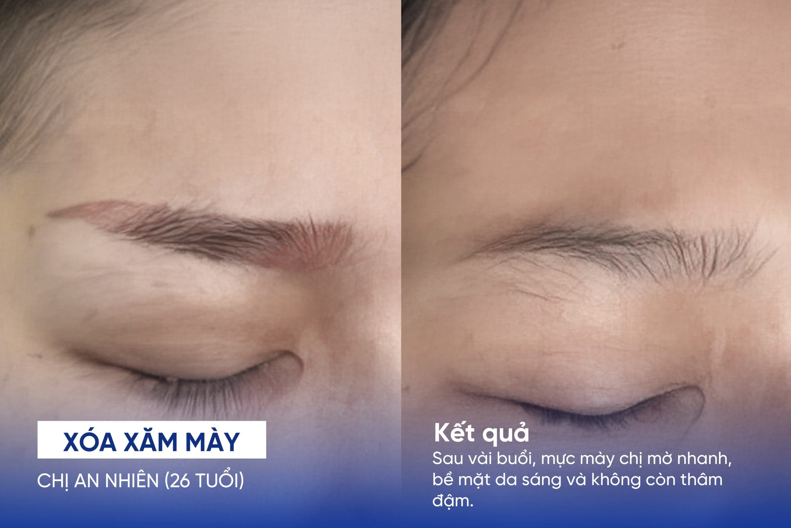 Kết quả xóa xăm mày của chị An Nhiên