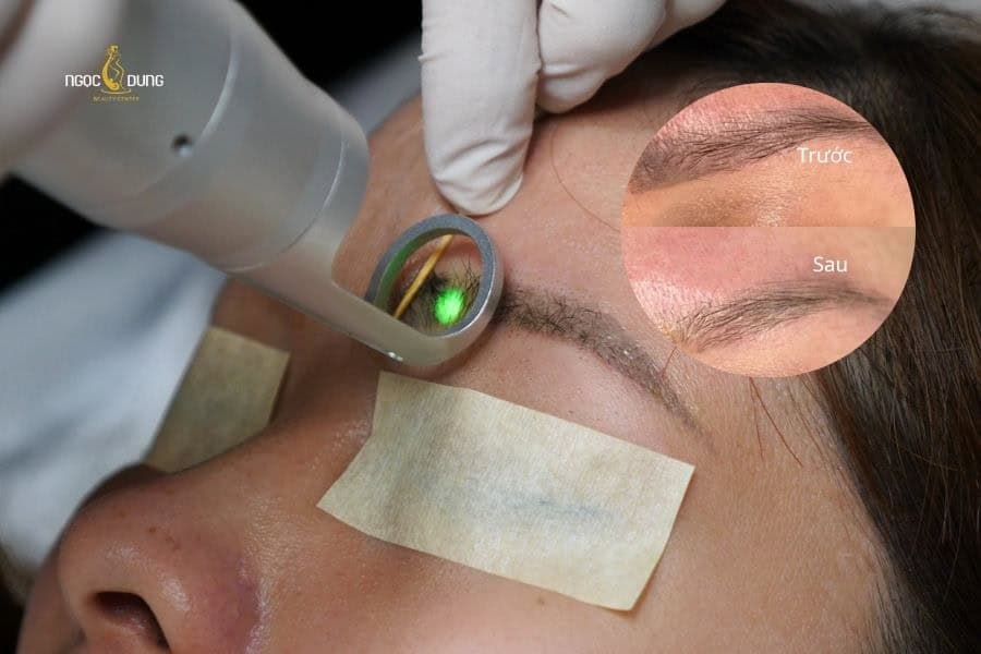 Xóa xăm lông màu bằng laser thường được cân nhắc khi dáng mày cũ không còn như mong muốn