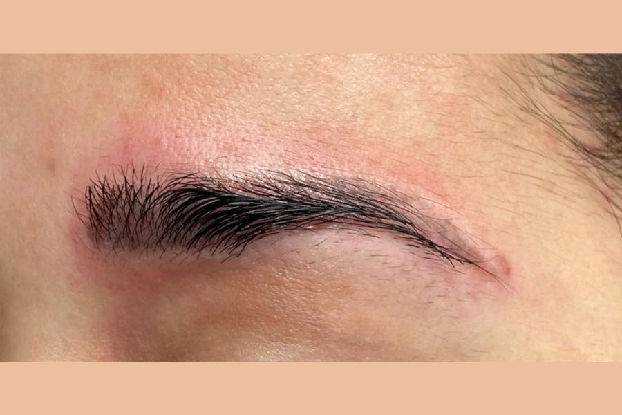 Kỹ thuật phun xăm cũ thường tác động nhiều vào da, gây ra tình trạng sưng tấy