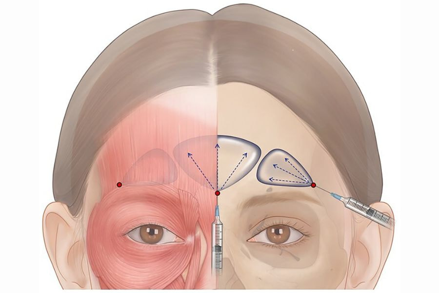 Tiêm filler đầy trán để có vầng trán đầy đặn