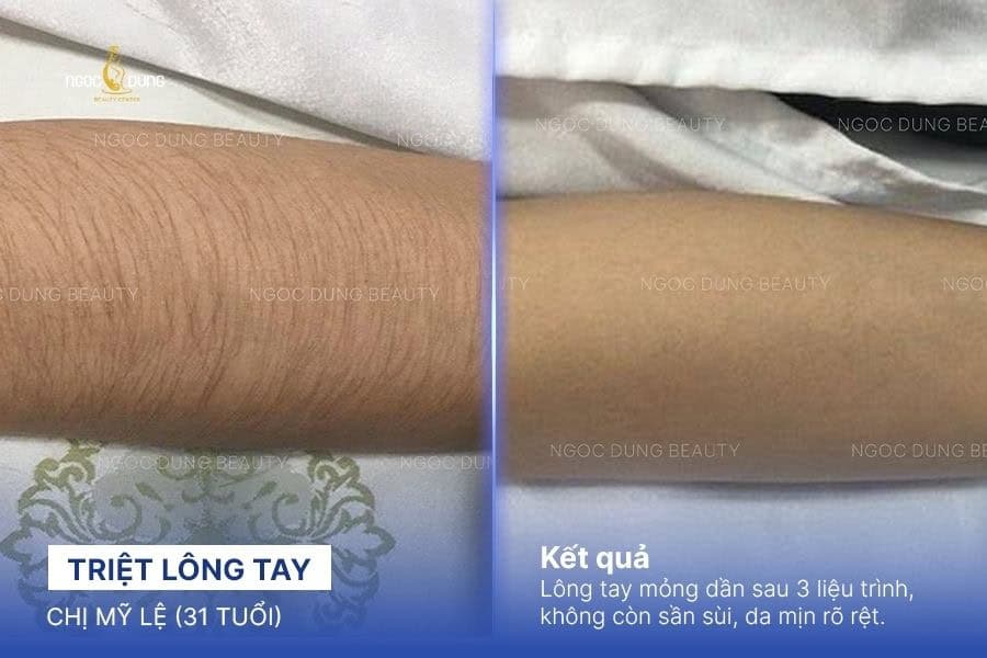 Quy trình triệt lông chuẩn y khoa tại viện Ngọc Dung 15 Kết quả triệt lông tại Ngọc Dung