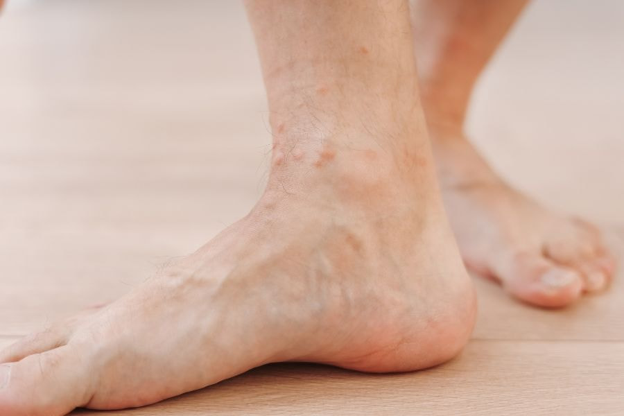 Triệt lông không đúng cách dễ gây ra tình trạng lông mọc ngược