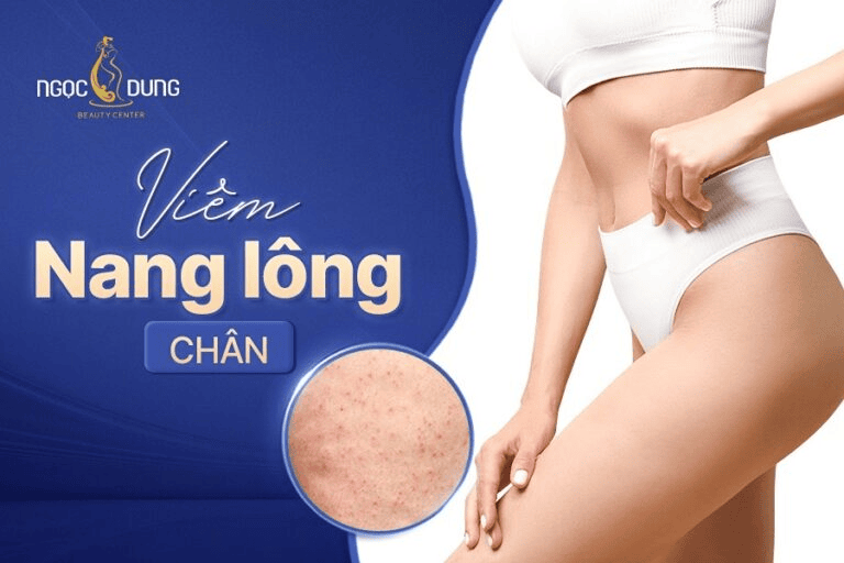Viêm nang lông chân có nguy hiểm không? 