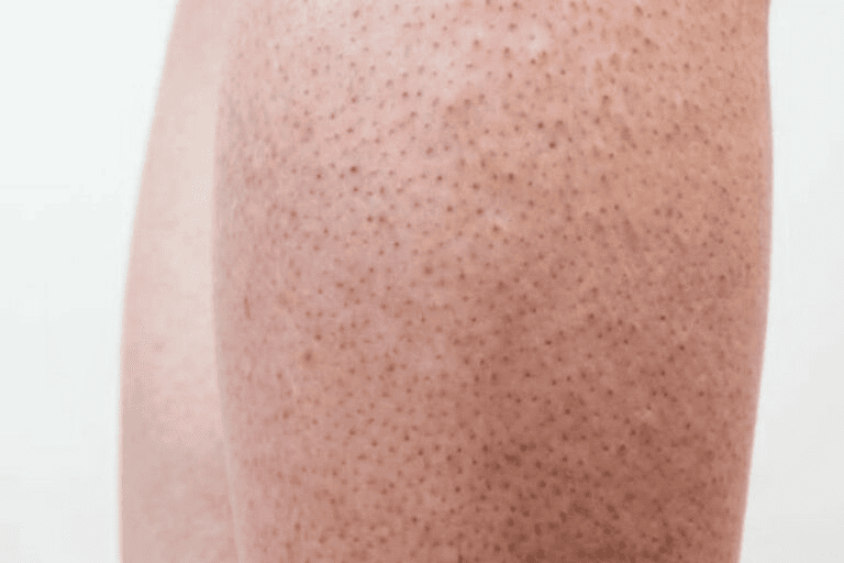 Viêm nang lông chân thường có nốt đỏ li ti gây ngứa và châm chích