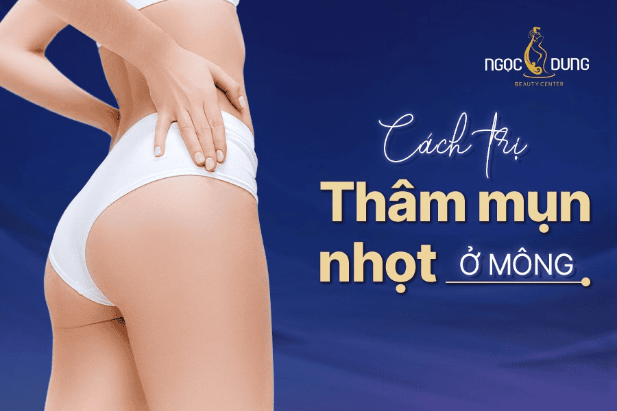 Cách trị thâm mụn nhọt ở mông hiệu quả và nhanh chóng
