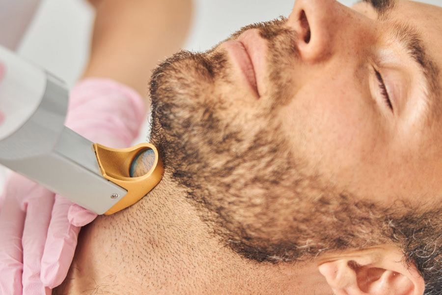 Cách triệt râu vĩnh viễn tại nhà: Hiểu đúng và lưu ý quan trọng