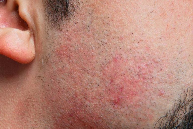 Cách triệt râu tại nhà: Hiểu đúng và lưu ý quan trọng