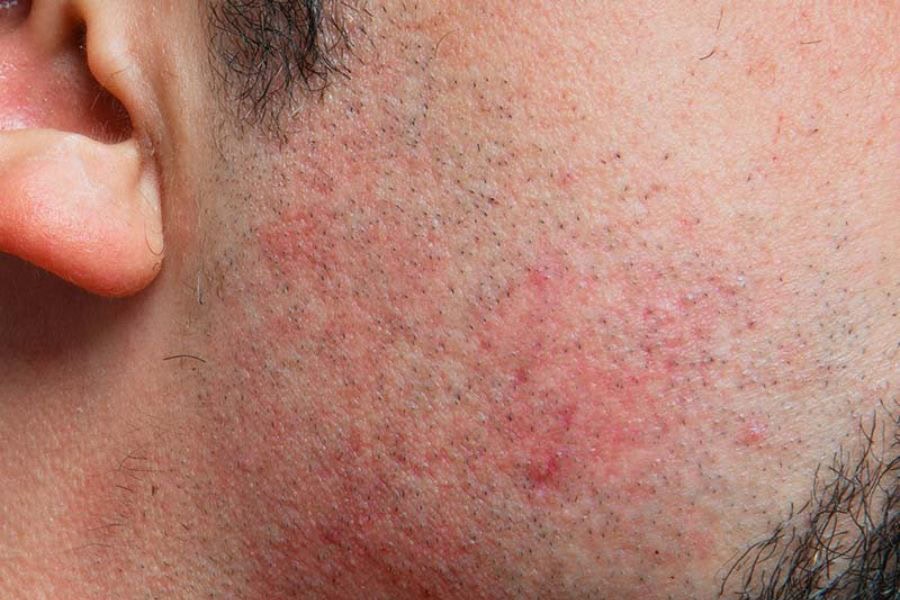 Triệt râu sai cách có thể gây kích ứng da