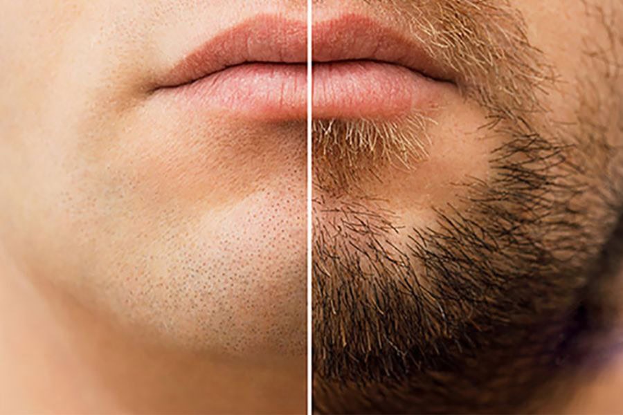 Triệt râu giúp gương mặt trẻ trung hơn