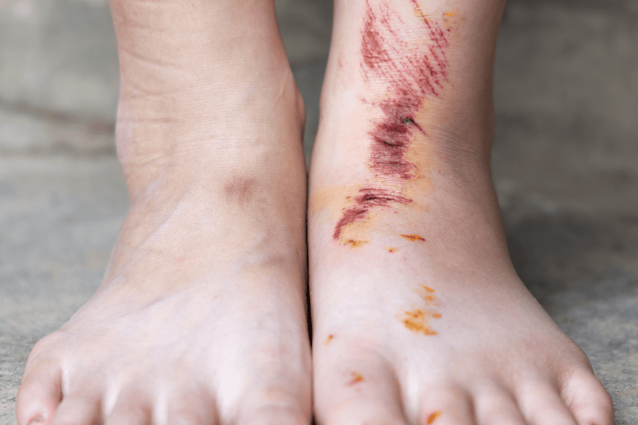 Nổi mẩn đỏ sau khi triệt lông chân có nguy hiểm không 15 Không nên triệt lông chân khi da đang trầy xước vì dễ gây tổn thương da