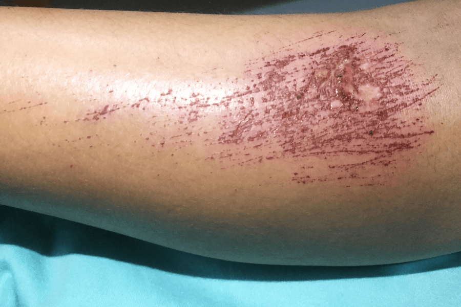 Cách wax lông chân tại nhà an toàn và dễ kiểm soát kích ứng 11 Không nên wax lông chân khi da đang tổn thương hoặc kích ứng