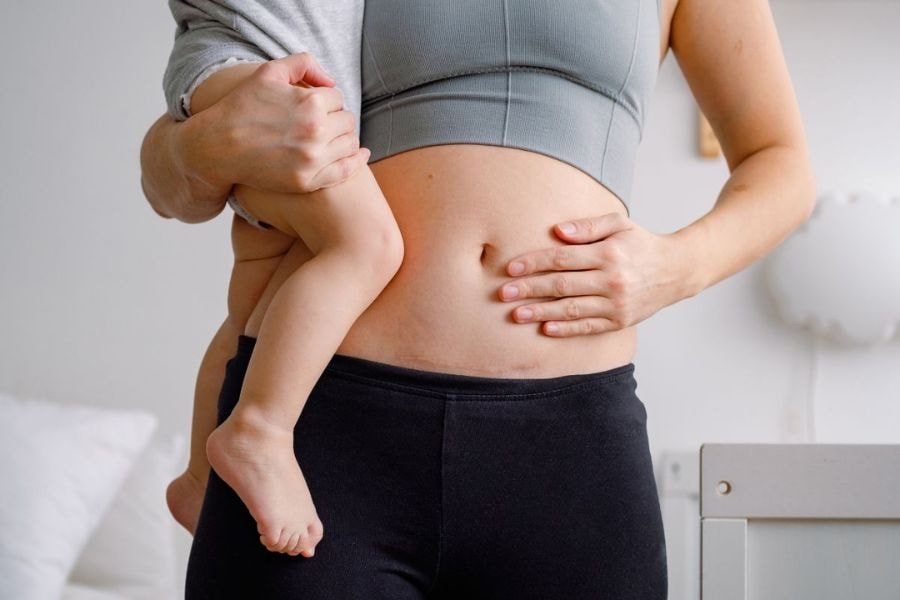 Thời gian hội phục sau sinh mổ làm mẹ bỉm không thể vận động mạnh trong thời gian dài nên khó giảm mỡ hơn