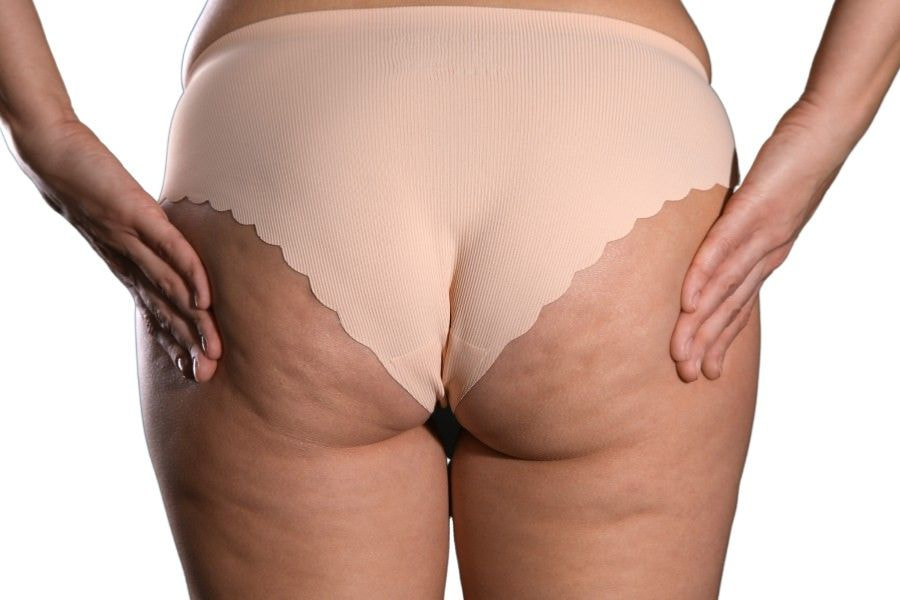 Mỡ mông làm mất thẩm mỹ và ảnh hưởng nhiều đến sức khỏe