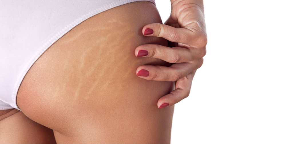 Rạn da là tình trạng các mô dưới da bị kéo căng do cơ thể phát triển nhanh chóng