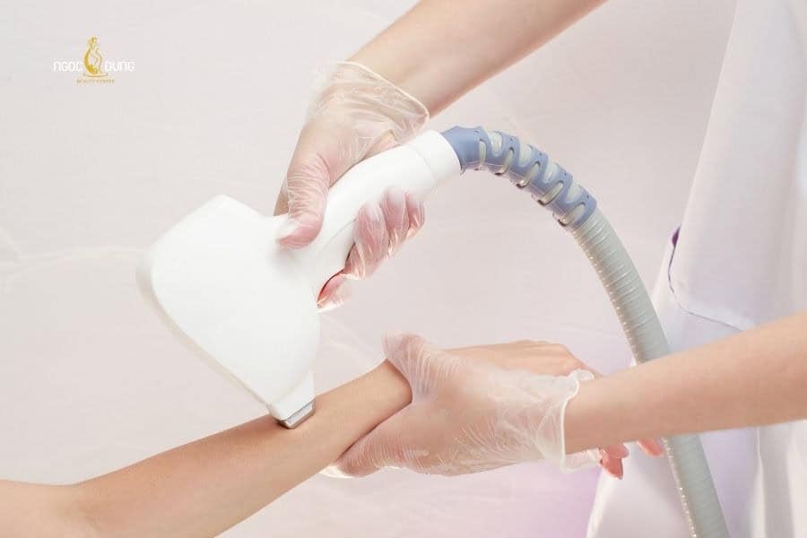 Triệt lông tay êm ái và hiệu quả bền vững tại Ngọc Dung