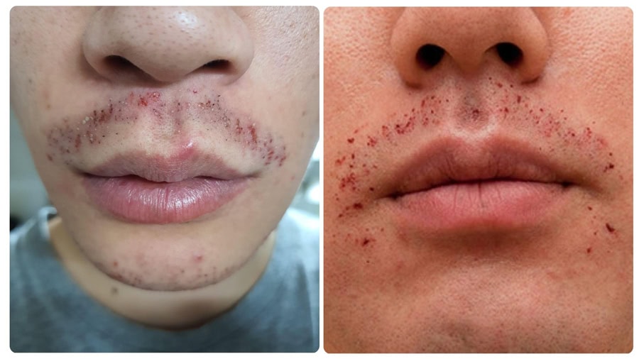 Cách triệt lông mặt nam an toàn và hiệu quả 12 Trường hợp da nhạy cảm cần lưu ý