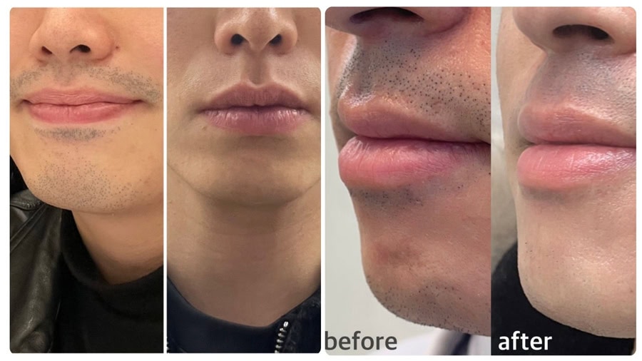 Cách triệt lông mặt nam an toàn và hiệu quả 11 Triệt lông mặt có tốt không