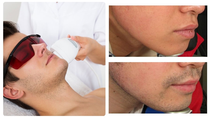 Cách triệt lông mặt nam an toàn và hiệu quả 10 Triệt lông mặt bằng công nghệ ánh sáng