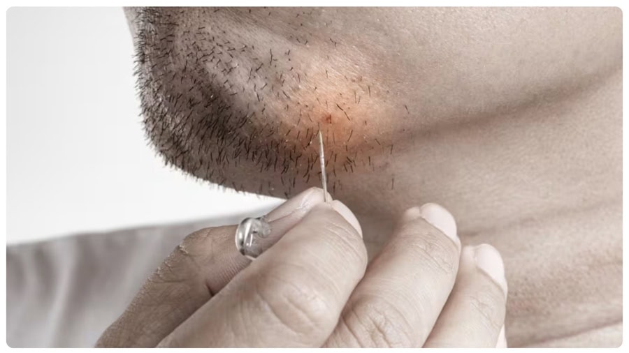 Cách triệt lông mặt nam an toàn và hiệu quả 9 Nhổ và waxing lông mặt