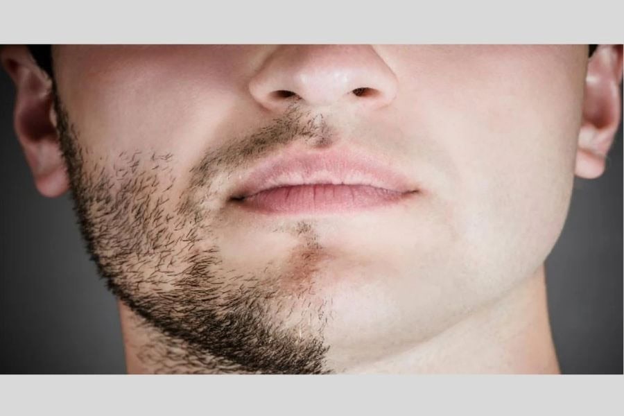 Triệt lông mặt vĩnh viễn cho nam: Tự tin và phong độ 3 Lông rậm ở nam giới chịu chi phối bởi hormone và di truyền