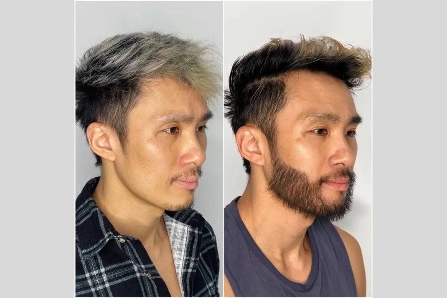 Triệt lông mặt vĩnh viễn cho nam: Tự tin và phong độ 4 Triệt lông mặt nam giới giúp gương mặt trông trẻ trung và rạng rỡ hơn