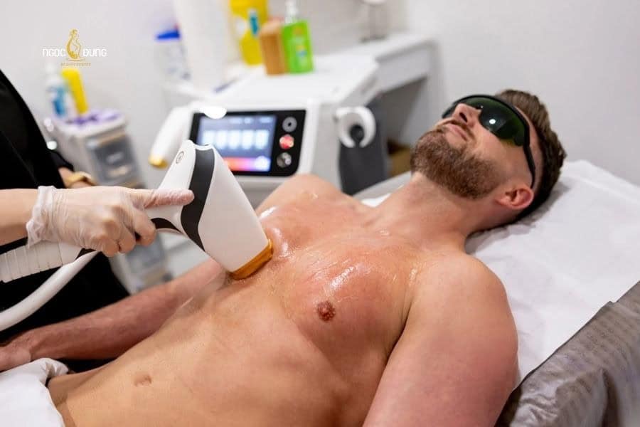 Triệt lông ngực tại spa mang đến hiệu quả lâu dài vì tác động trực tiếp của nang lông