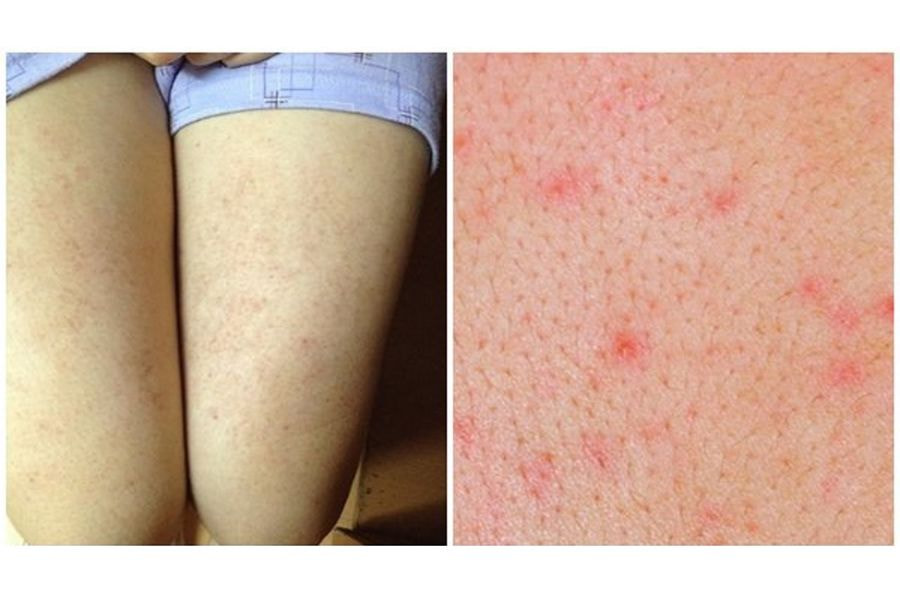 Viêm nang lông cũng là một rủi ro thường gặp sau khi triệt lông chân