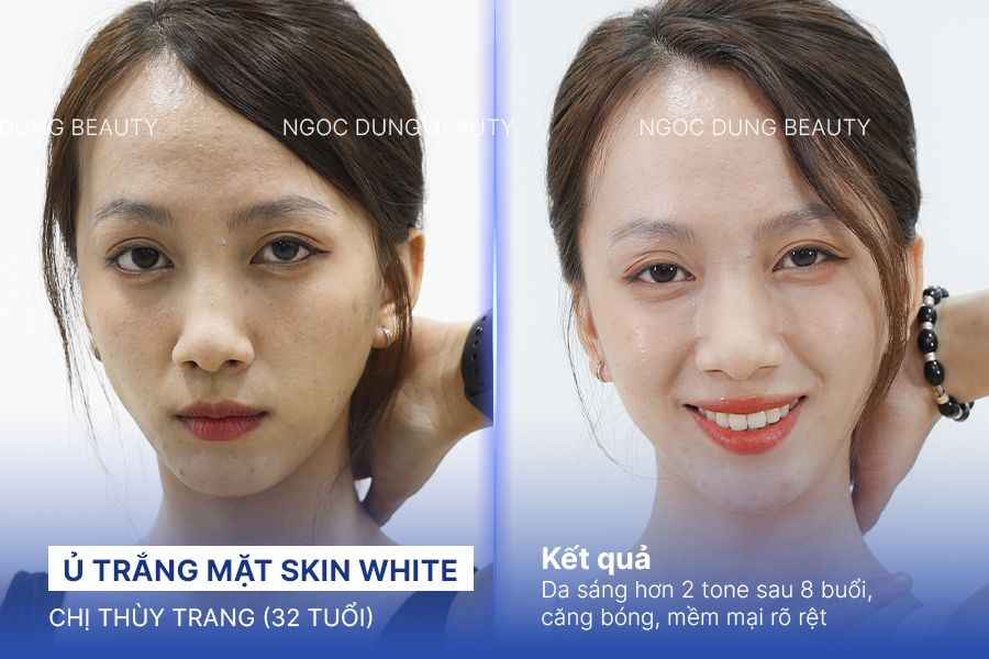 Ủ trắng mặt skin white – 8 buổi – Da trắng hơn 2 tone