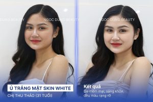 Chị Thu Thảo (31 tuổi) - Ủ Trắng Mặt Skin White