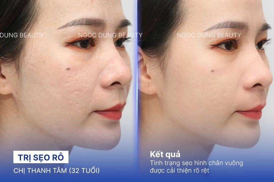 Chị Thanh Tâm (32 tuổi) - Trị Sẹo Rỗ
