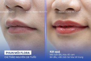Chị Thảo Nguyên (28 tuổi) - Phun Môi Flora