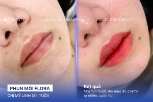 Chị Mỹ Linh (34 tuổi) - Phun Môi Flora