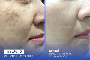 Chị Hồng Phúc (37 tuổi) - Trị Sắc Tố