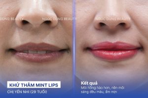 Chị Yến Nhi (29 tuổi) - Khử Thâm Mint Lips