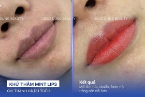 Chị Thanh Hà (31 tuổi) - Khử Thâm Mint Lips