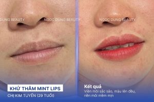 Chị Kim Tuyến (29 tuổi) - Khử Thâm Mint Lips