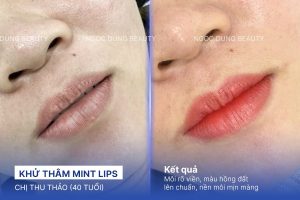 Chị Thu Thảo (40 tuổi) - Khử Thâm Mint Lips